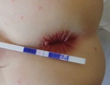 Dermatitis perianal con test rÃ¡pido de detecciÃ³n de EBHGA